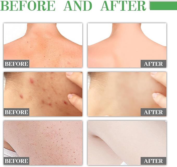 Jaysuing - L ' Body Acne Removing Essence