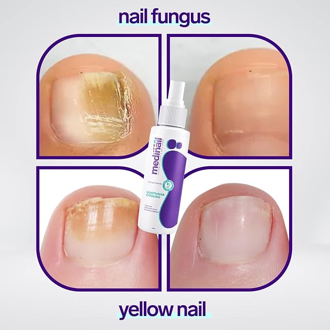Jaysuin - Nail Fungus Spray